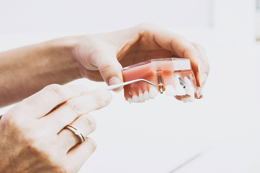 Prótesis dental fija - Estética dental - BFEstéticaDental