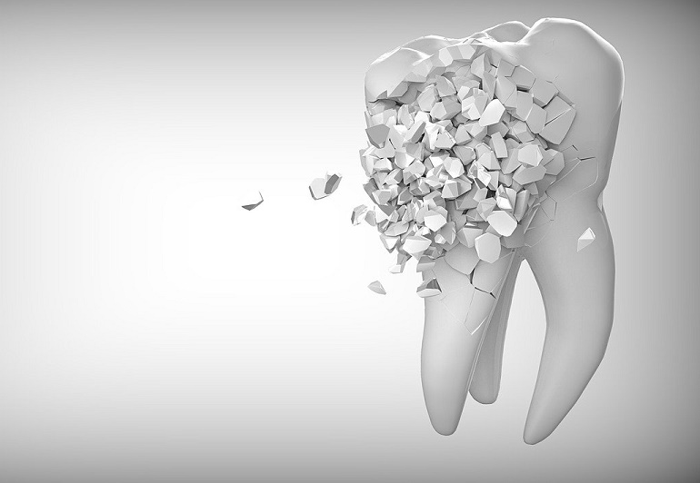 Enfermedad periodontal - encías - BFEstéticaDental