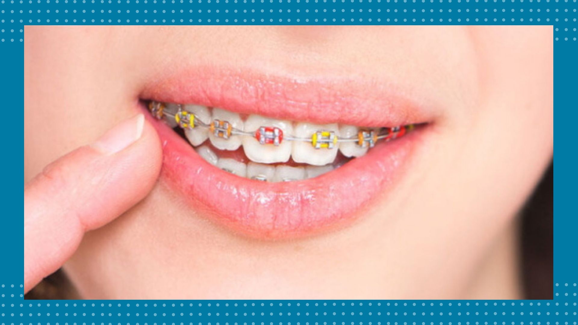 Centro odontológico - Ortodoncia - New BF-Estetica-Dental- Brakets-Caracas-Venezuela