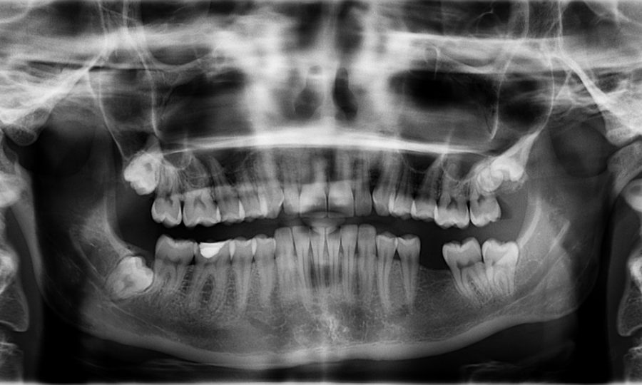 edentulismo-odontología-BFEsteticadental