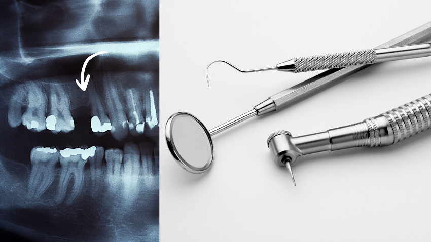 Agenesia dental - ausencia de diente - BFEstéticaDental