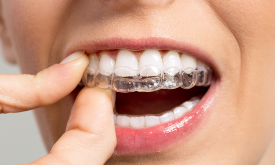 Ortondoncia invisible alineadores invisibles BDestetica Dental