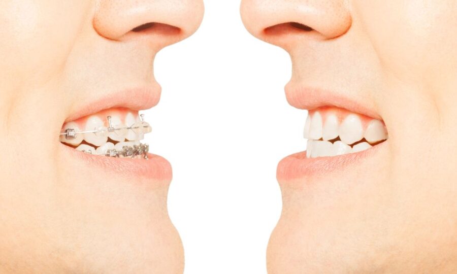 Clase I bfesteticadental imagen principal