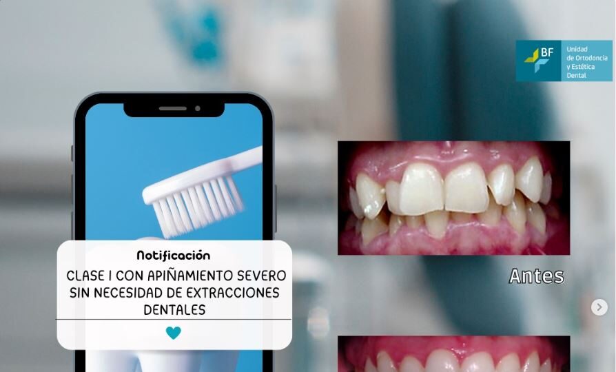 Apiñamiento severo Bfesteticadental 1