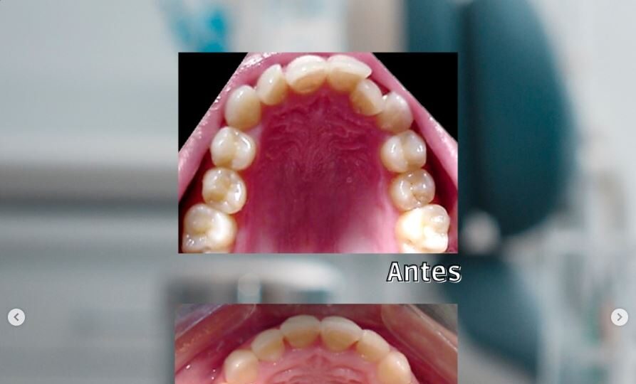 Bfesteticadental Apiñamiento severo 2