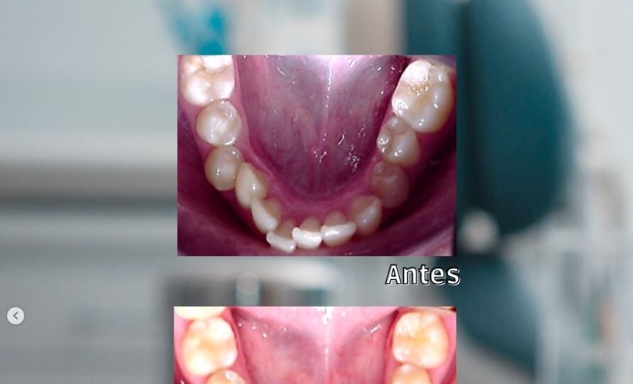 Apiñamiento severo 3 Bfesteticadental