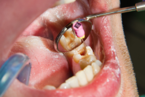 Endodoncia - Tipos de endodoncia - BFEstéticaDental