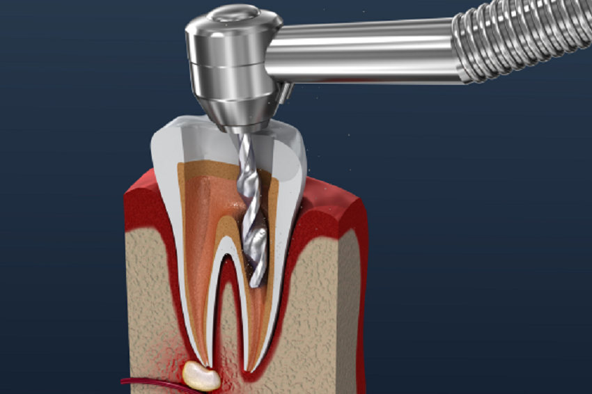 Tipos de endodoncias - proceso endodóncico - BFEstéticaDental