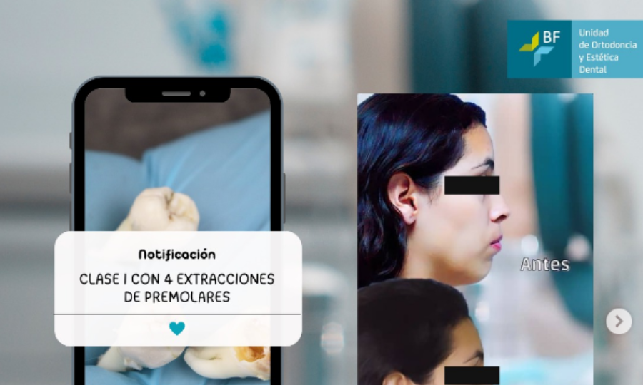 4-extracciones-de-premolares