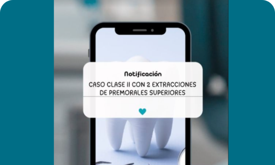 Clase II 2 Extracciones de Premolares imagen destacada