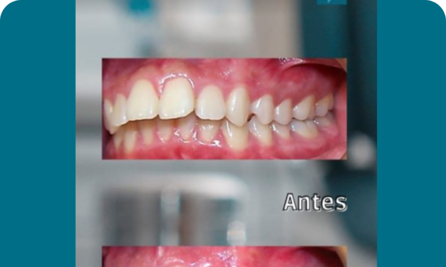Extracciones Premolares Superiores Clase II 3