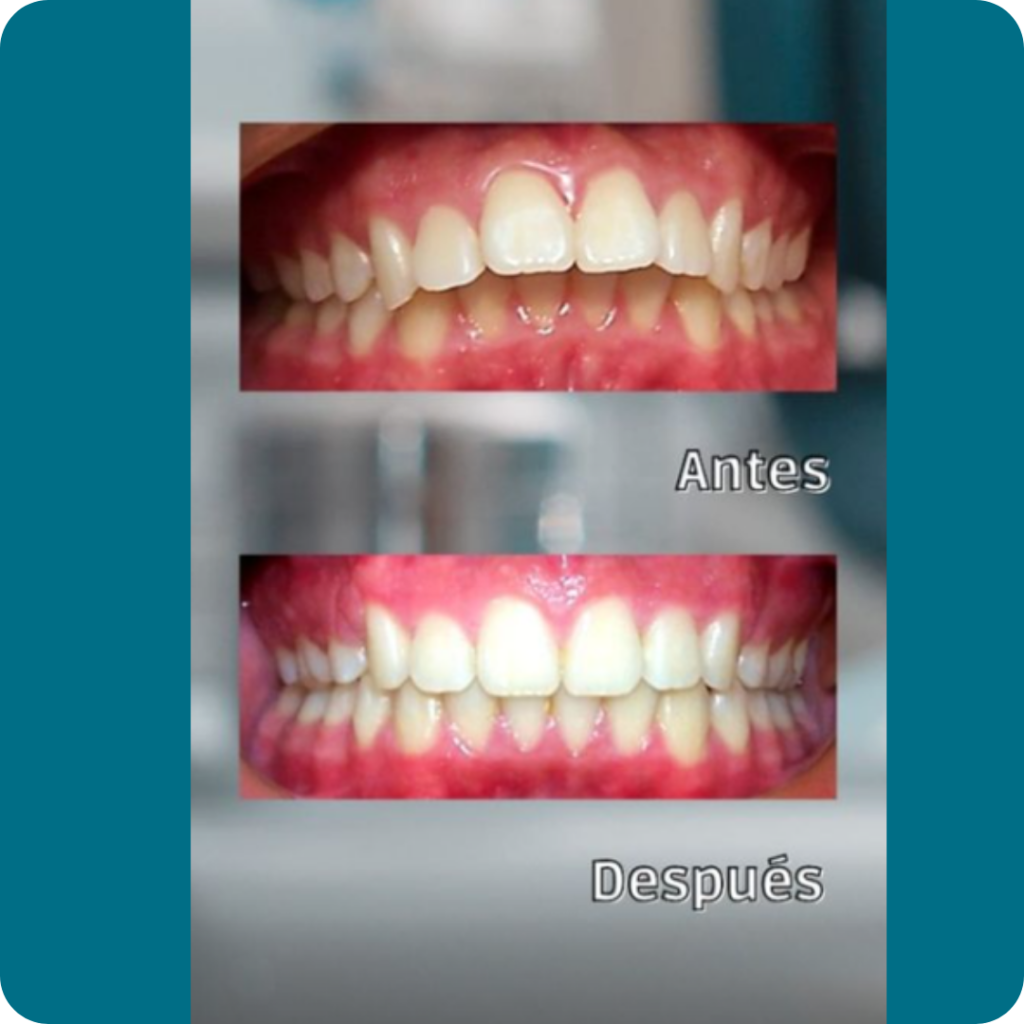 Premolares Superiores Clase II 4