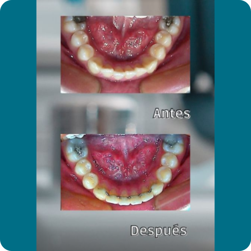 Premolares Superiores Clase II 5