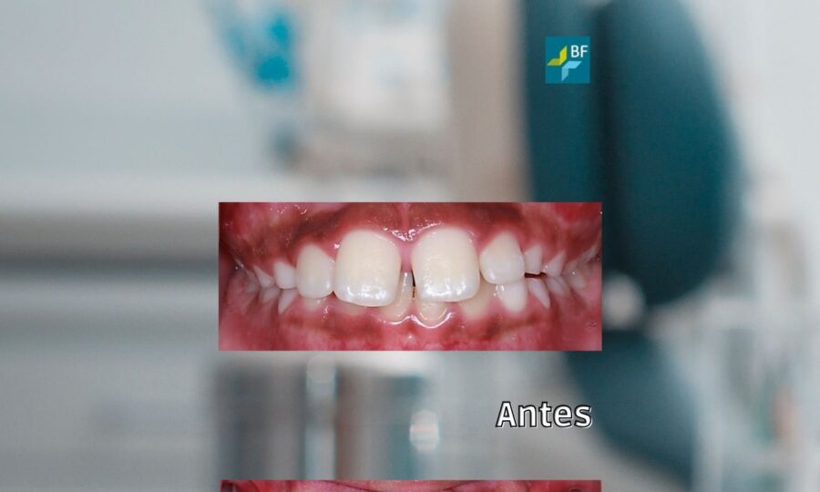 Microimplantes Clase II BFesteticadental 4