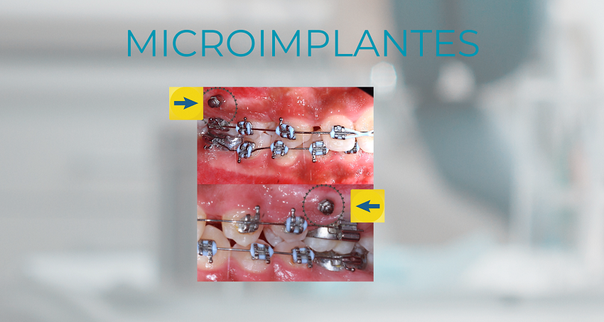 Microimplantes - implantes 2 - BFEstéticaDental