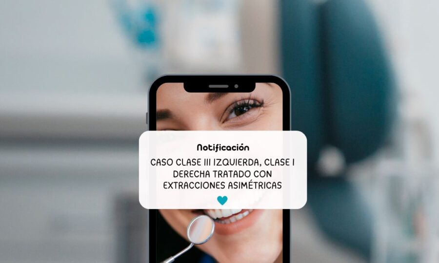 Extracciones asimetricas BF estetica Dental 1