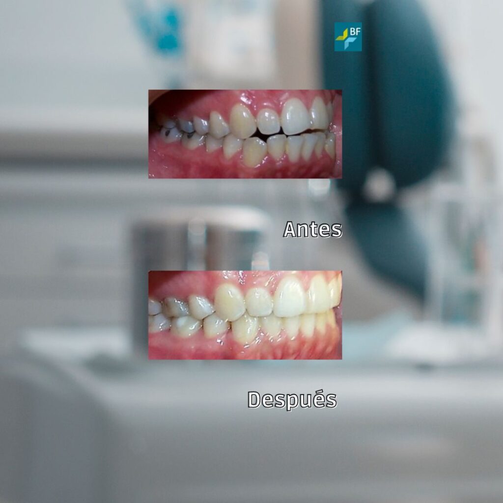 Extracciones asimetricas BF estetica Dental (2)