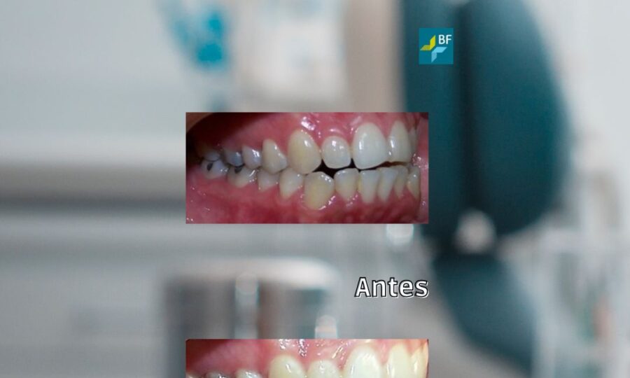Extracciones asimetricas BF estetica Dental (2)