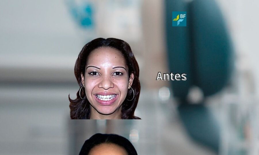 Extracciones asimetricas BF estetica Dental otro
