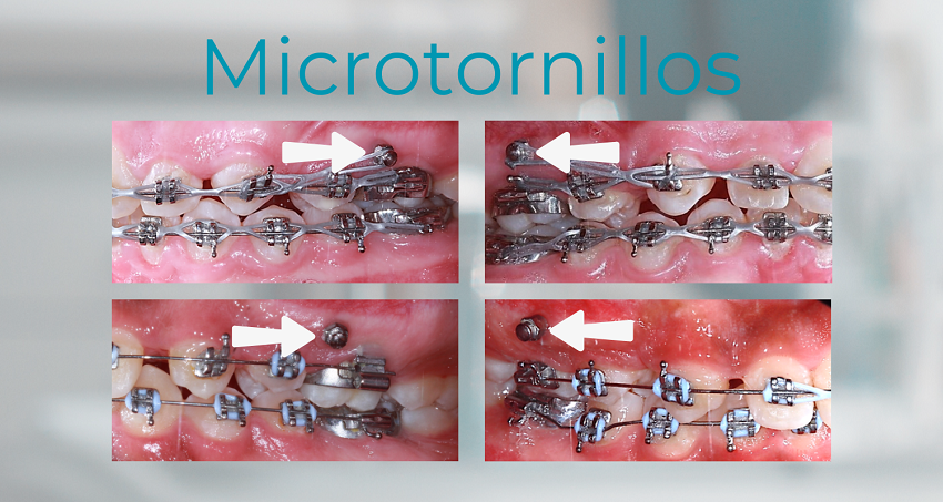 Microtornillos - Mini implantes - BFEstéticaDental