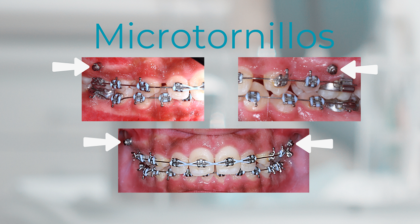 Microtornillos - Minitornillos - BFEstéticaDental