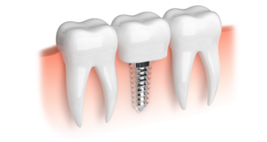 PREGUNTAS FRECUENTES - implantes - BF Estética Dental