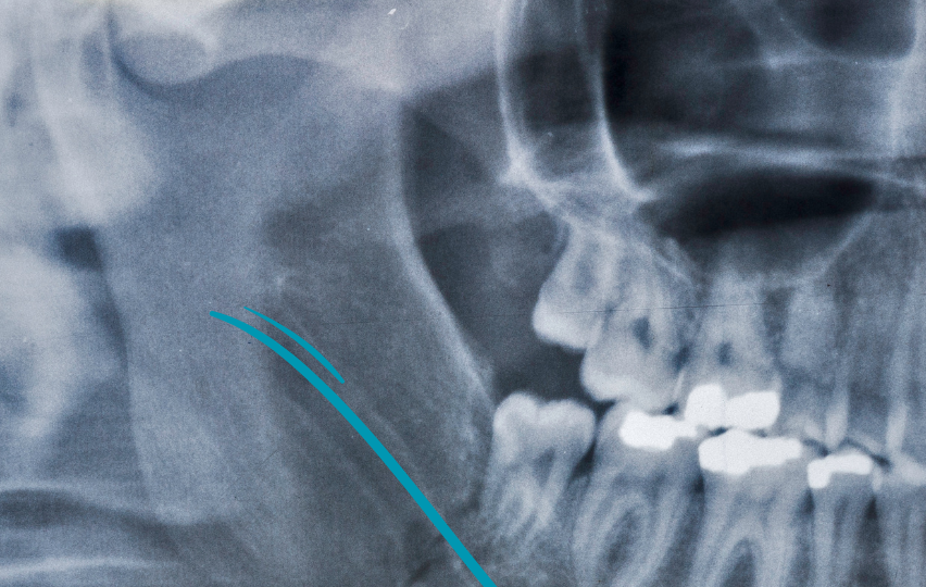 Conducto Alveolar Inferior (CAI) - mandíbula - BFEstéticaDental