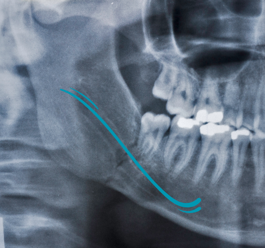 Conducto Alveolar Inferior (CAI) - mandíbula - BFEstéticaDental