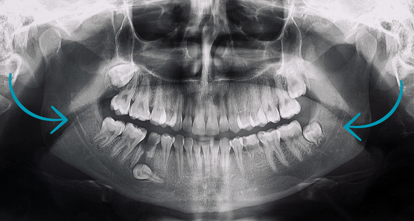 Conducto Alveolar Inferior (CAI) - odontología - BFEstéticaDental