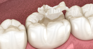 Incrustaciones dentales - Beneficios - BFEstéticaDental