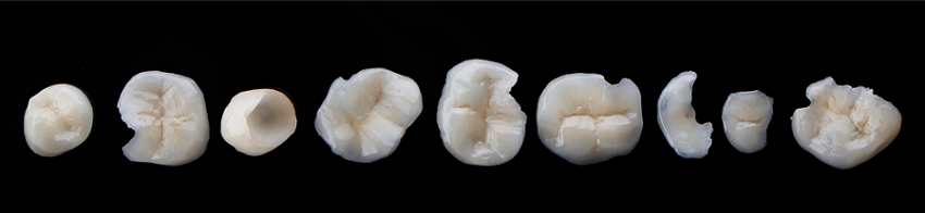 Incrustaciones dentales - Materiales - BFEstéticaDental