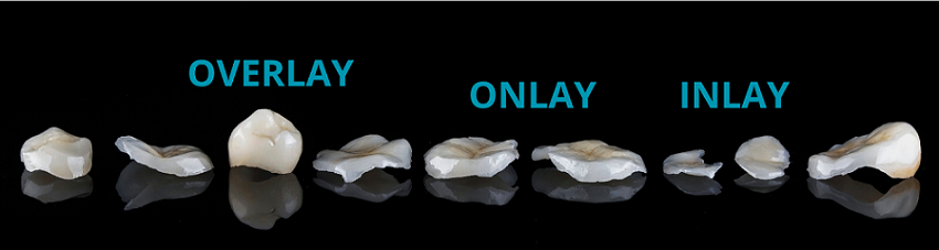 Incrustaciones dentales - Restauraciones - BFEstéticaDental