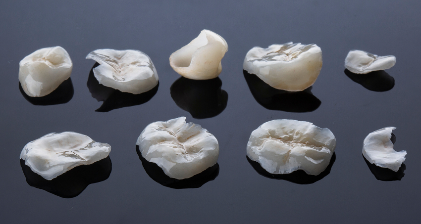 Incrustaciones dentales - Tipos - BFEstéticaDental