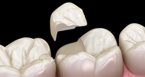Estética dental - técnica restauradora - BFEstéticaDental